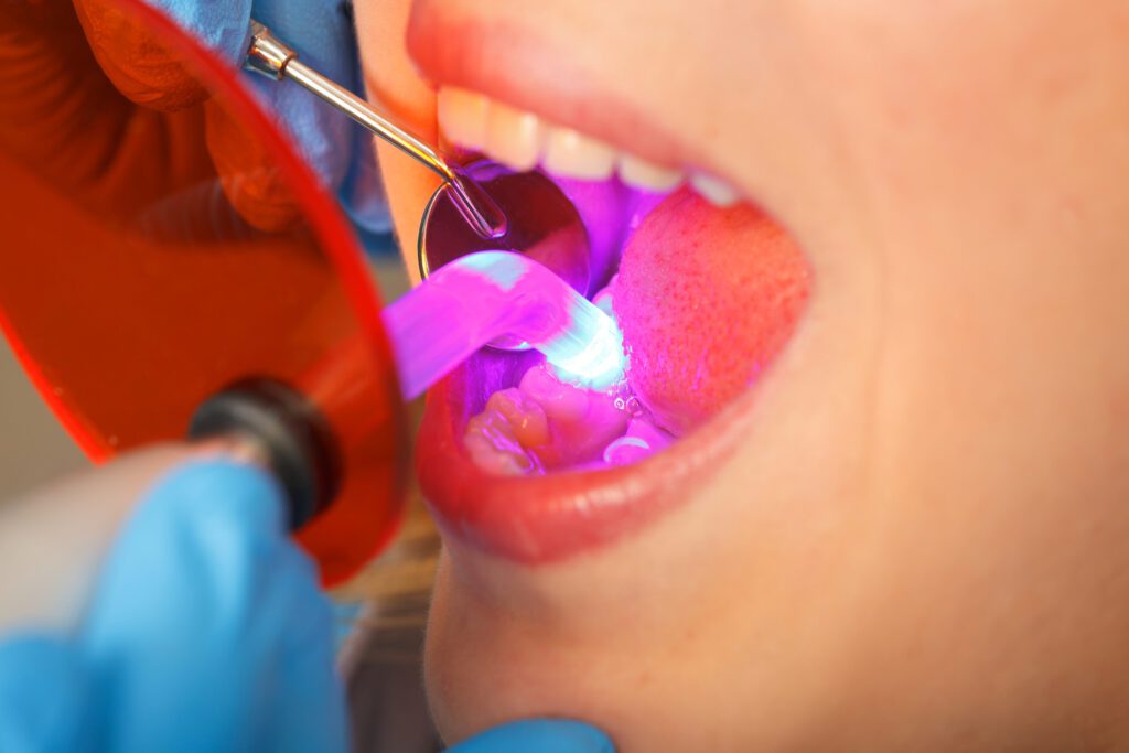 Teeth Bonding in Plano TX